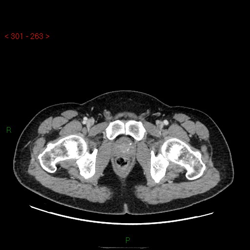 Ampullary carcinoma (Radiopaedia 56396-63056 C 103).jpg