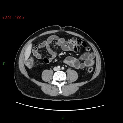 File:Ampullary carcinoma (Radiopaedia 56396-63056 C 60).jpg