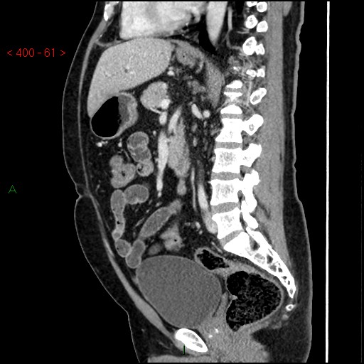 Ampullary carcinoma (Radiopaedia 56396-63056 D 60).jpg