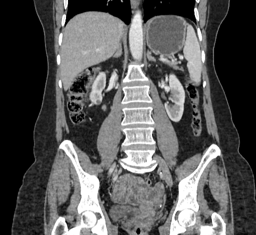 Ampullary tumor (Radiopaedia 60333-67998 B 47).jpg