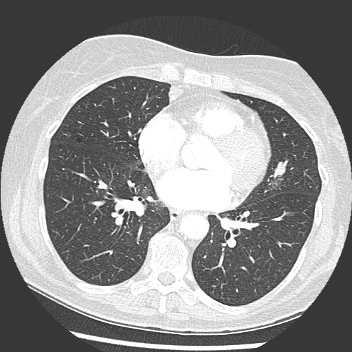 Amyloidosis - bronchial and diffuse nodular pulmonary involvement (Radiopaedia 60156-67745 Axial lung window 51).jpg