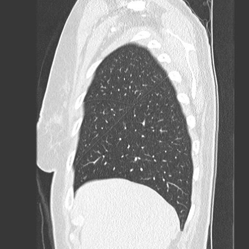Amyloidosis - bronchial and diffuse nodular pulmonary involvement (Radiopaedia 60156-67745 Sagittal lung window 14).jpg