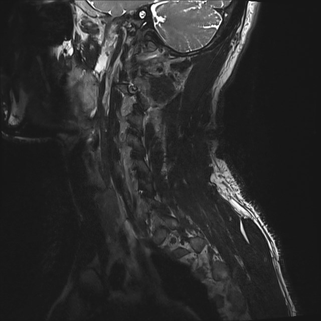 Amyotrophic lateral sclerosis (Radiopaedia 87352-103658 I 59).jpg