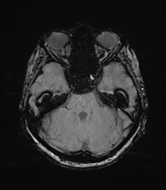 Anaplastic astrocytoma (Radiopaedia 86943-103160 Axial SWI 30).png