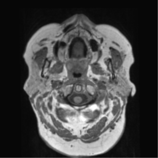 File:Anaplastic astrocytoma IDH wild-type (pseudoprogression) (Radiopaedia 42209-45278 Axial T1 13).png