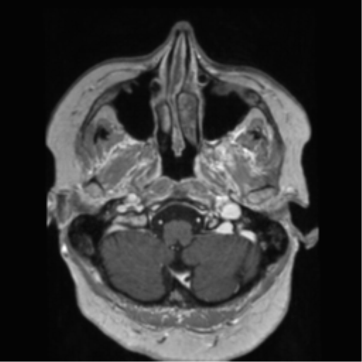 File:Anaplastic astrocytoma IDH wild-type (pseudoprogression) (Radiopaedia 42209-45278 Axial T1 C+ 32).png