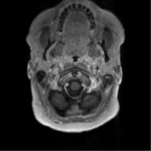 Anaplastic oligodendroglioma (Radiopaedia 83500-98599 Axial T1 C+ 7).png