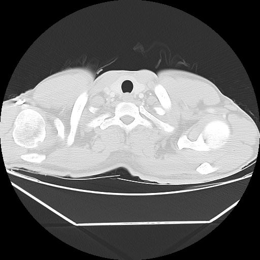 Aneurysmal bone cyst - rib (Radiopaedia 82167-96220 Axial lung window 9).jpg
