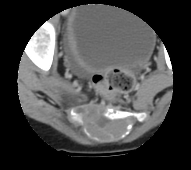 Aneurysmal bone cyst - sacrum (Radiopaedia 65190-74195 Axial non-contrast 35).jpg