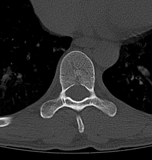 Aneurysmal bone cyst T11 (Radiopaedia 29294-29721 Axial bone window 23).jpg