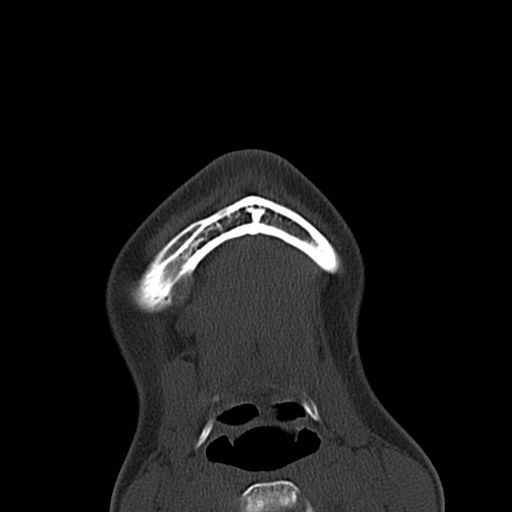 Aneurysmal bone cyst of the mandible (Radiopaedia 43280-46601 Axial bone window 2).jpg