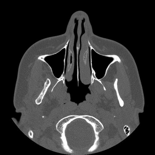 Aneurysmal bone cyst of the mandible (Radiopaedia 43280-46823 Axial bone window 114).jpg