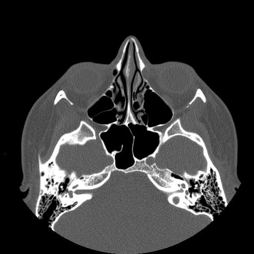 Aneurysmal bone cyst of the mandible (Radiopaedia 43280-46823 Axial bone window 155).jpg