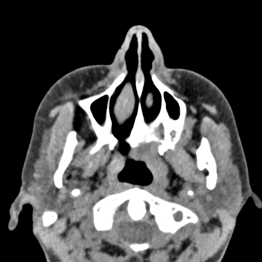 Angular dermoid cyst (Radiopaedia 88967-105790 Axial non-contrast 8).jpg