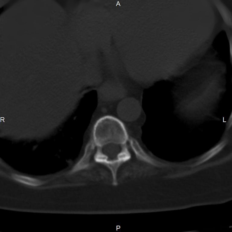 Ankylosing spondylitis (Radiopaedia 8748-9556 Axial bone window 4).jpg