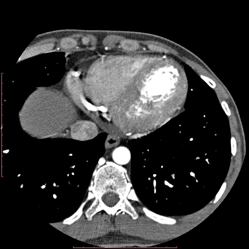 Anomalous left coronary artery from the pulmonary artery (ALCAPA) (Radiopaedia 70148-80181 A 310).jpg