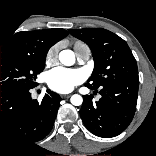 Anomalous left coronary artery from the pulmonary artery (ALCAPA) (Radiopaedia 70148-80181 A 88).jpg