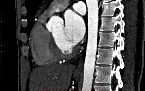 File:Anomalous left coronary artery from the pulmonary artery (ALCAPA) (Radiopaedia 70148-80181 C 127).jpg