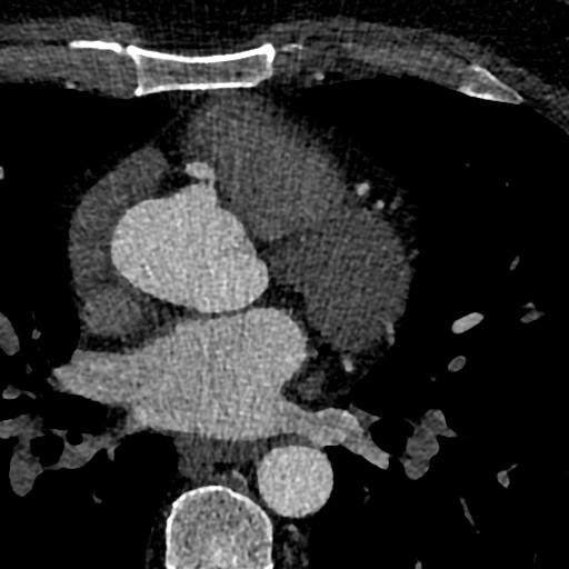 File:Anomalous origin of the left coronary artery with malignant course (Radiopaedia 77842-90126 C 61).jpeg