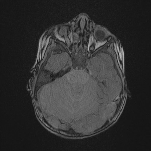 Anoxic brain injury (Radiopaedia 79165-92139 Axial MRA 67).jpg