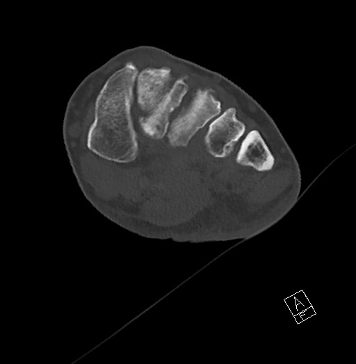 Anterior calcaneal process fracture (Radiopaedia 63353-71943 Axial bone window 75).jpg