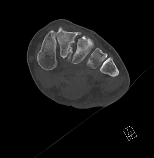 File:Anterior calcaneal process fracture (Radiopaedia 63353-71943 Axial bone window 77).jpg