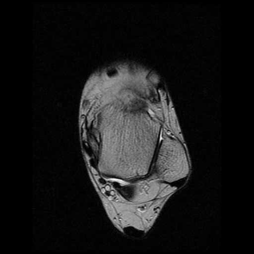 File:Anterior calcaneal process fracture (Radiopaedia 74654-85611 Axial T2 9).jpg