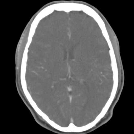 File:Anterior cerebral artery territory infarct (Radiopaedia 39327-41581 B 28).png