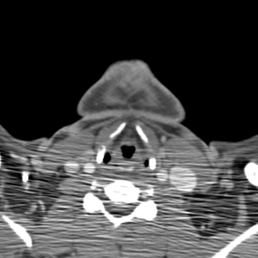 Anterior cerebral artery territory infarct (Radiopaedia 39327-41581 B 83).png