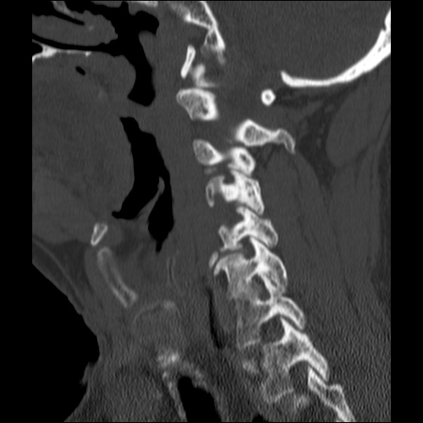 Anterior cervical postdiscectomy arthrodesis (Radiopaedia 32678-33646 Sagittal bone window 26).jpg