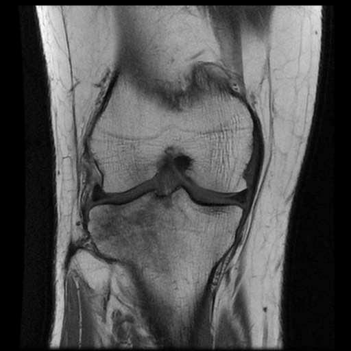File:Anterior cruciate ligament avulsion fracture (Radiopaedia 58939-66193 Coronal T1 11).jpg