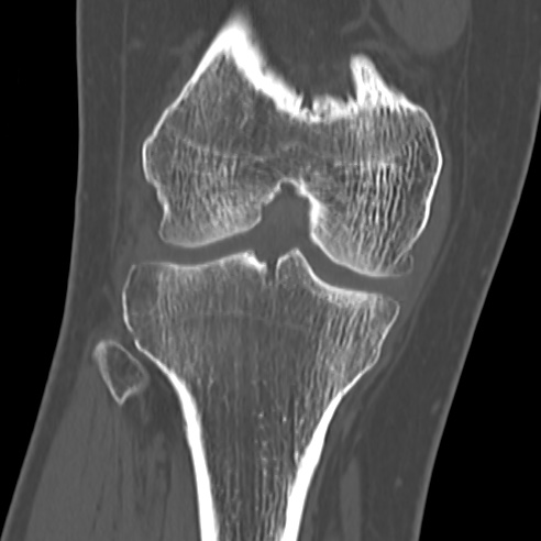 File:Anterior cruciate ligament avulsion fracture (Radiopaedia 58939-66194 Coronal bone window 17).jpg
