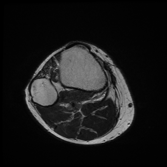 File:Anterior cruciate ligament graft tear and bucket-handle tear of medial meniscus (Radiopaedia 75867-87254 Axial T2 1).jpg