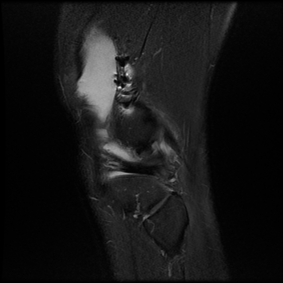 File:Anterior cruciate ligament graft tear and bucket-handle tear of medial meniscus (Radiopaedia 75867-87255 Sagittal PD fat sat 25).jpg