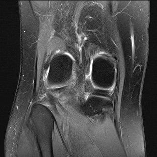 File:Anterior cruciate ligament rupture and posteromedial corner injury (Radiopaedia 67338-76723 Coronal PD fat sat 6).jpg