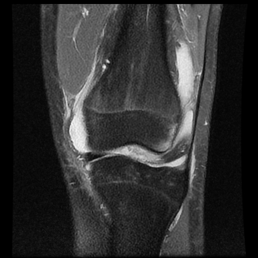 File:Anterior cruciate ligament tear (Radiopaedia 61500-69462 Coronal PD fat sat 8).jpg