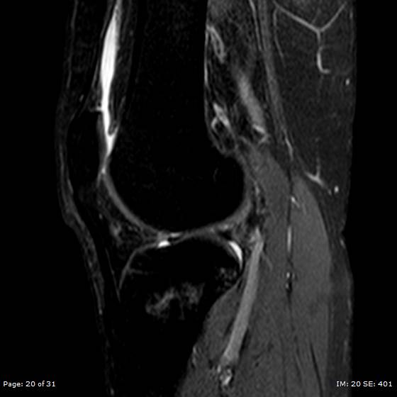 File:Anterior cruciate ligament tear (Radiopaedia 70783-80964 Sagittal STIR 20).jpg