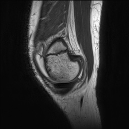 Anterior cruciate ligament tear - pediatric (Radiopaedia 62152-70260 Sagittal PD 31).jpg