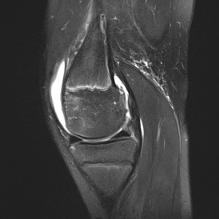 File:Anterior cruciate ligament tear - pediatric (Radiopaedia 62152-70260 Sagittal PD fat sat 13).jpg