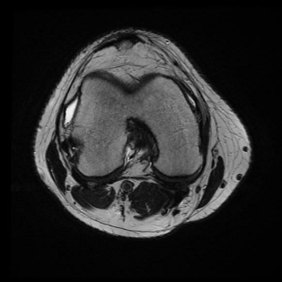 File:Anterior cruciate ligament tear with posteromedial corner injury, bucket-handle meniscal tear and chondral delamination (Radiopaedia 75501-86744 Axial T2 13).jpg