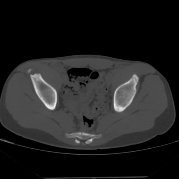 Anterior inferior iliac spine avulsion fracture (Radiopaedia 49469-54627 Axial bone window 29).jpg