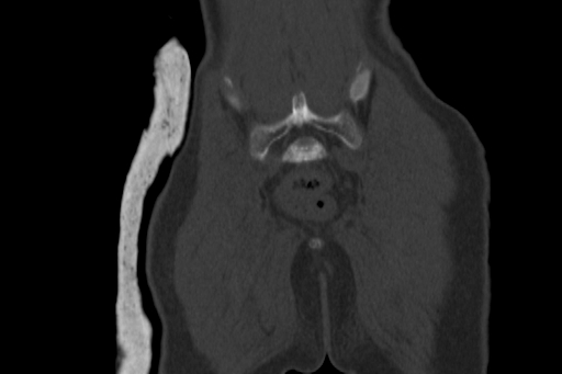 Anterior inferior iliac spine avulsion injury (Radiopaedia 88666-105376 Coronal bone window 62).jpg