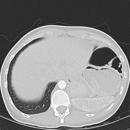 Anterior mediastinal lymphoma (Radiopaedia 29556-30061 Axial lung window 49).jpg