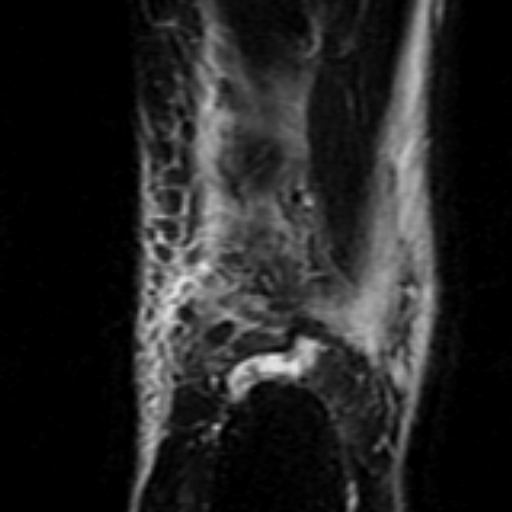 File:Anterior talofibular ligament rupture (Radiopaedia 15831-15484 Coronal STIR 20).jpg