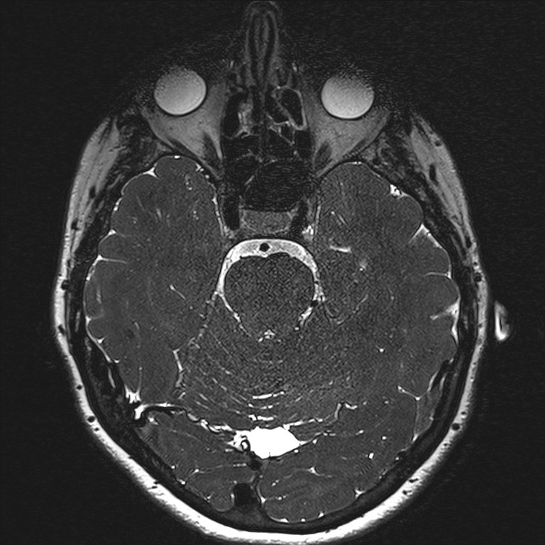 Anterior temporal encephalocele (Radiopaedia 82624-96808 Axial T2 high res 62).jpg