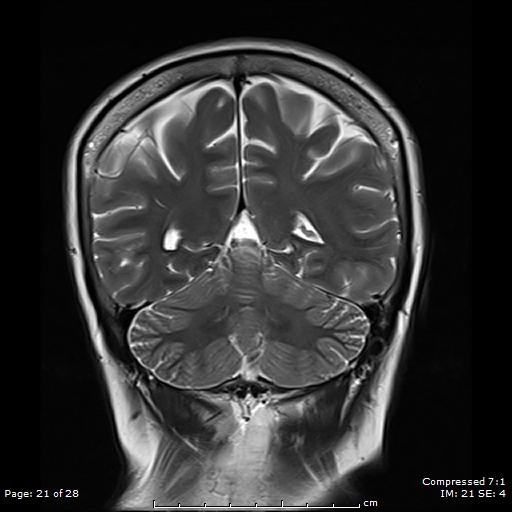File:Anterior temporal lobe perivascular space (Radiopaedia 88283-104914 Coronal T2 21).jpg