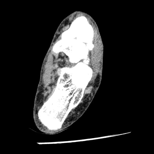 Anterior tibial artery false aneurysm (Radiopaedia 88984-105809 A 180).jpg