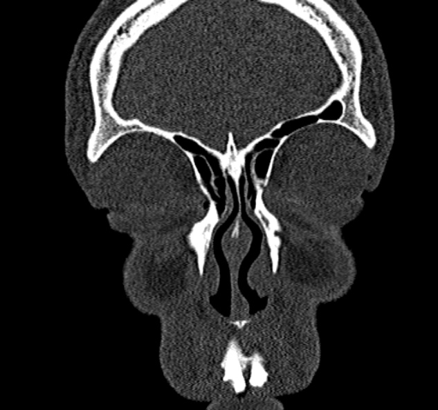 Antrochoanal polyp (Radiopaedia 30002-30554 Coronal bone window 19).jpg