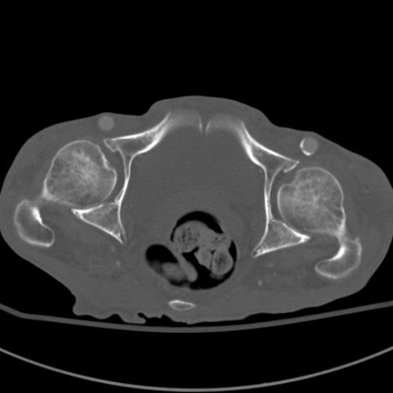 Aortic aneurysm with spinal destruction (Radiopaedia 42301-45410 Axial bone window 108).jpg