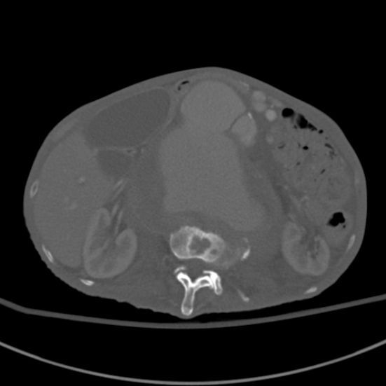 Aortic aneurysm with spinal destruction (Radiopaedia 42301-45410 Axial bone window 37).jpg